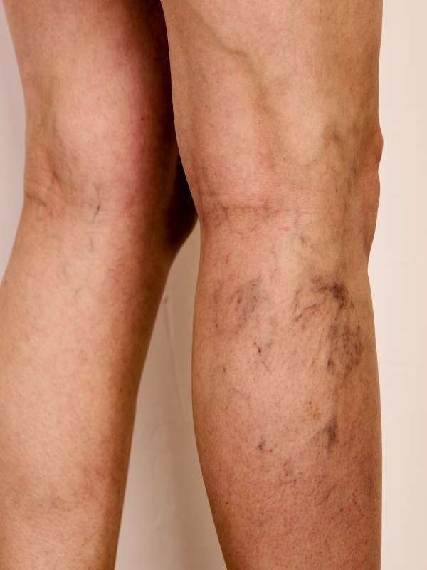 Spider Veins